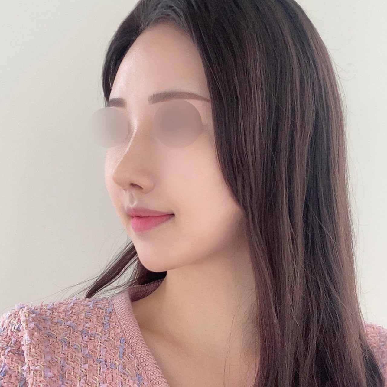 매부리 복코 수술 3개월차에요