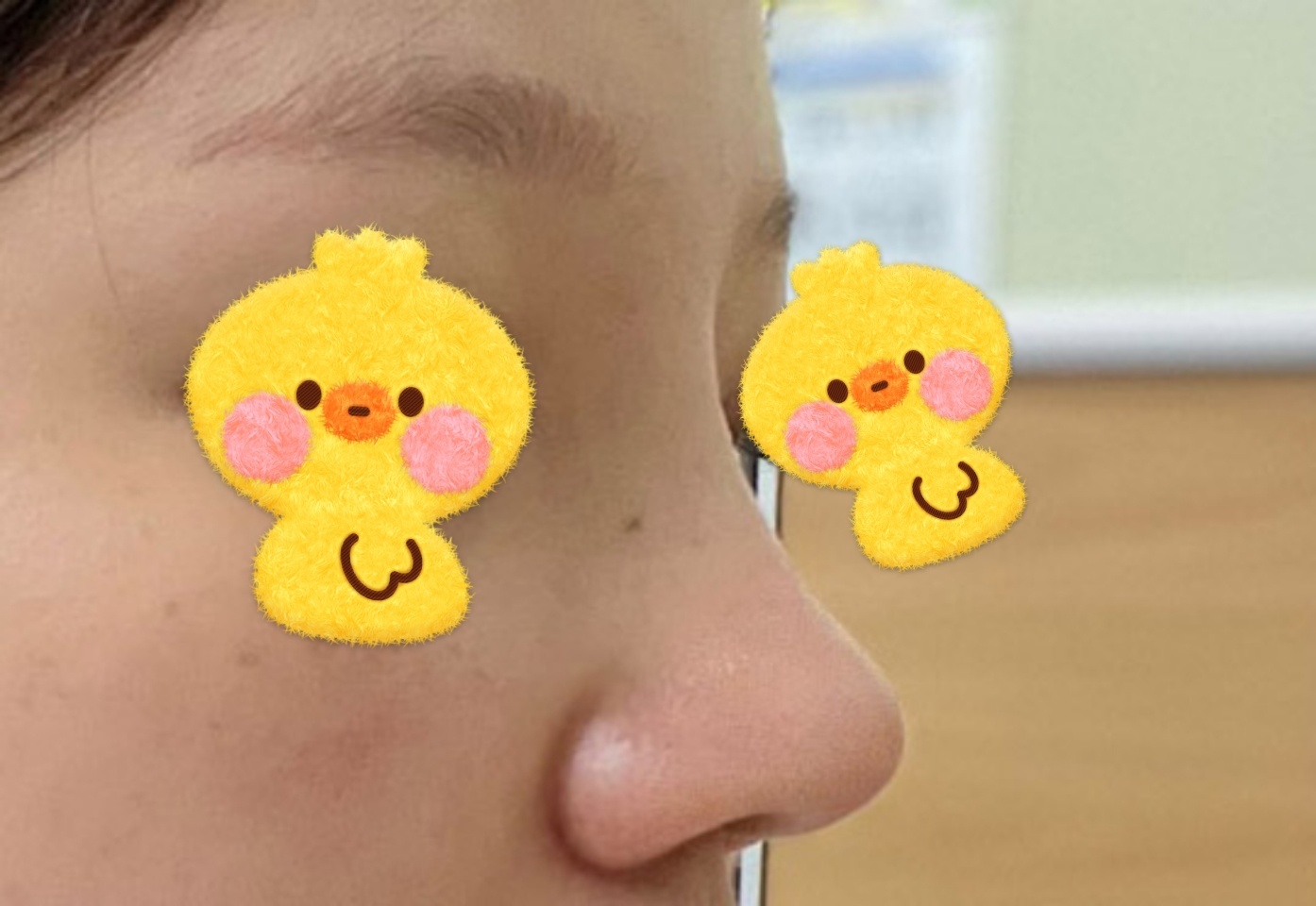 코재수술 잘된후기!원장님 감사해요!