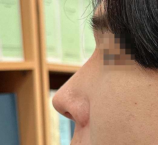 남자첫코수술 4개월차후기!기능코도 했어요~