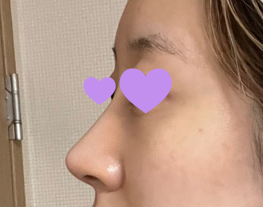 무보형물 4개월차에요ㅎㅎ