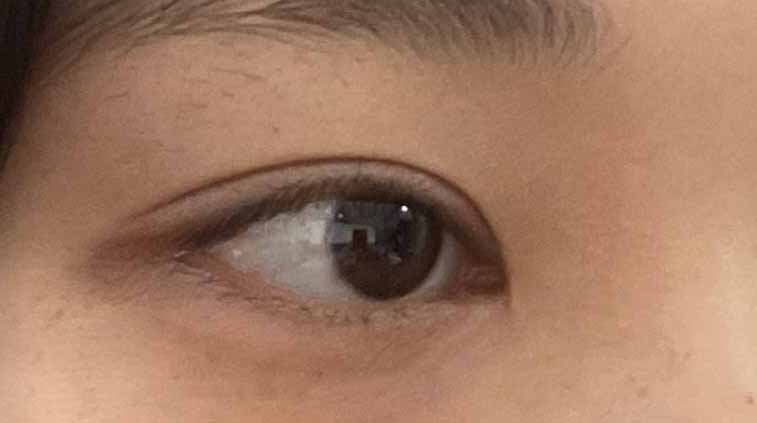 수술후 이미지가 바뀌어서 너무 좋습니다!