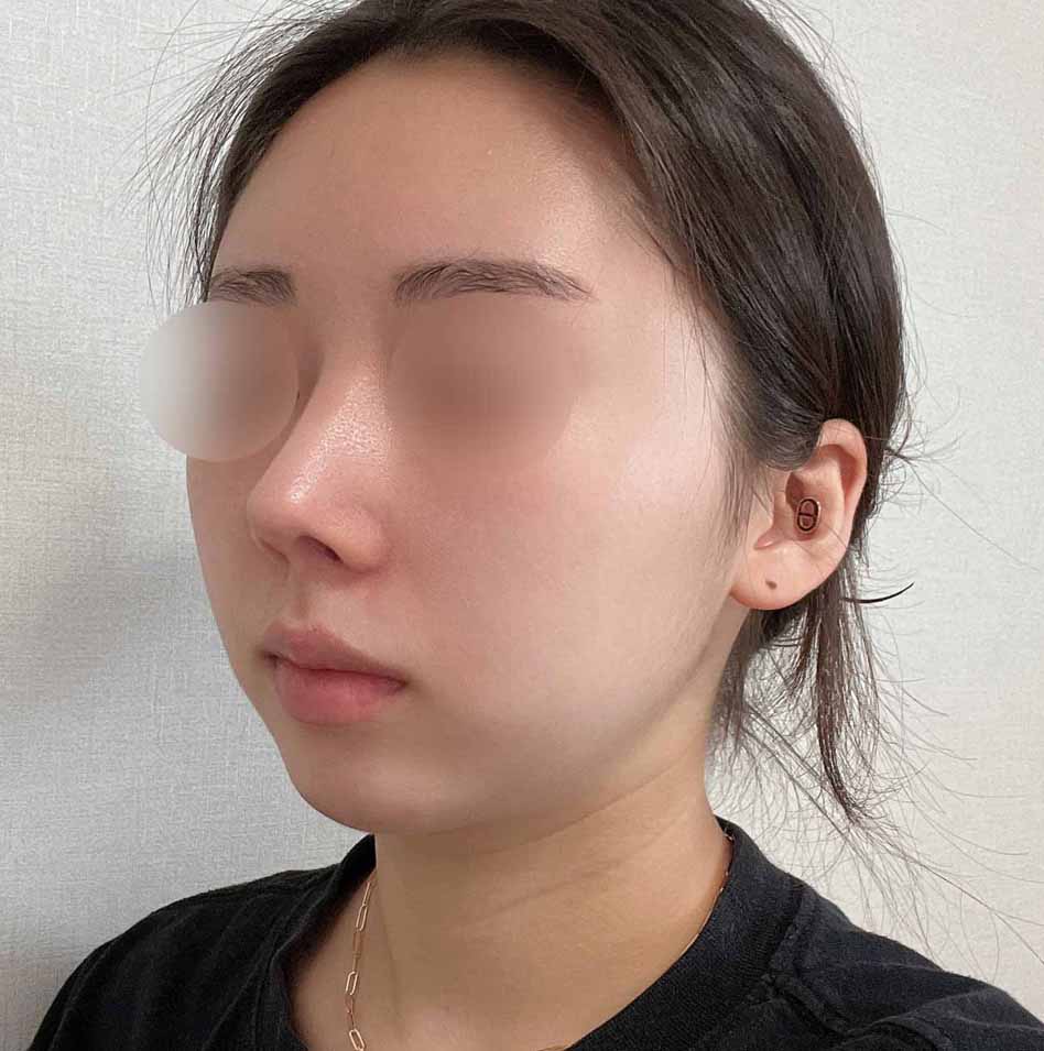 코 + 풀페이스지방이식 강추 ㅋㅋ