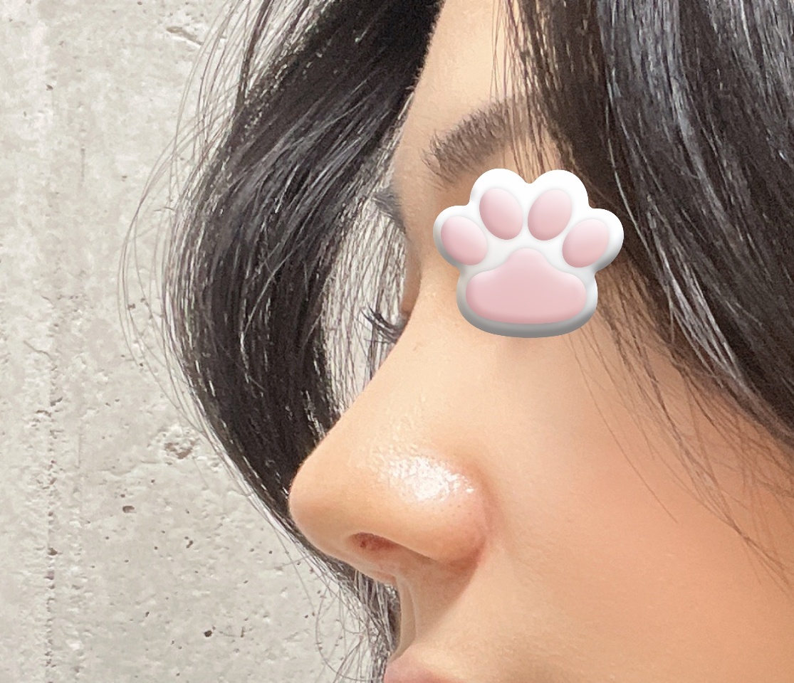 역싀 무보형물코수술맛집!!