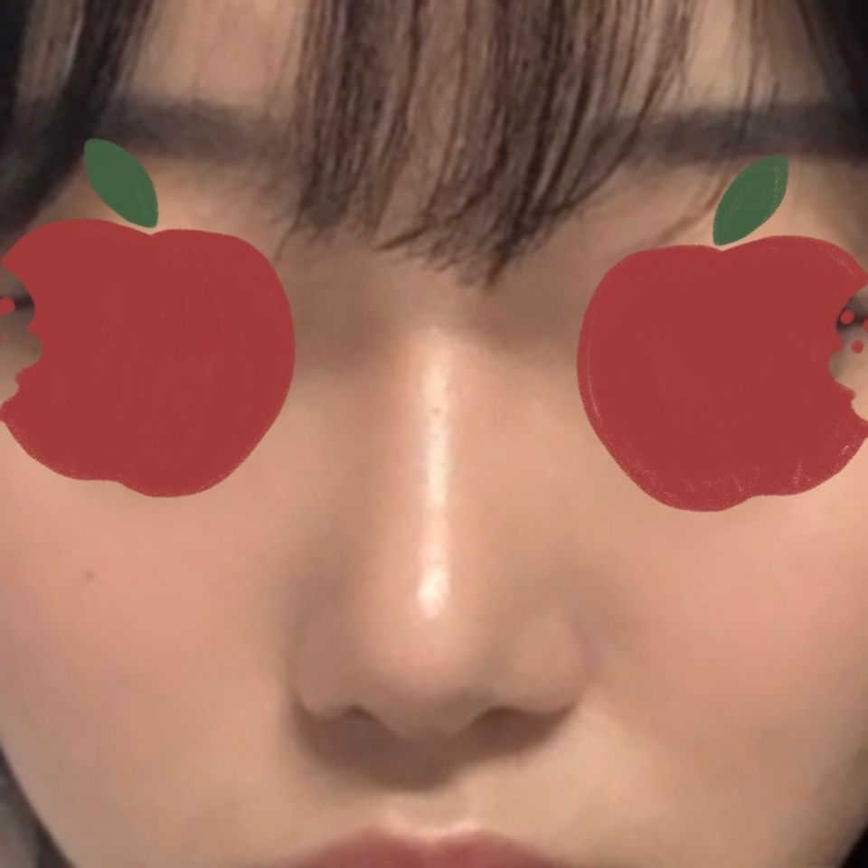 주변에도 코수술 바이브추천드리고파요~~