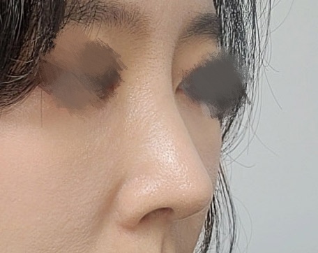 눈,코 4개월차~~