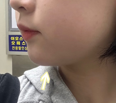 오래 고민한 끝에 바이브에서 얼굴지방흡입 했습니다:)