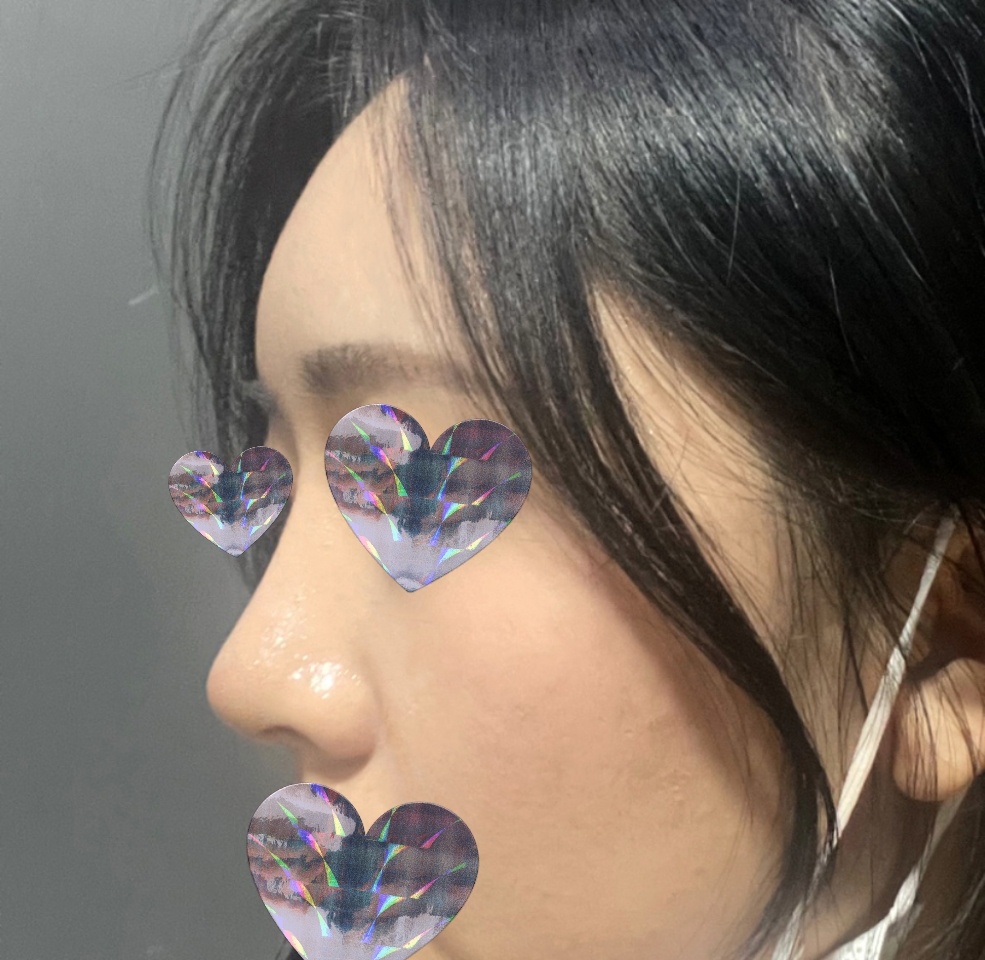 코+지방이식 만족스런 결과임니당