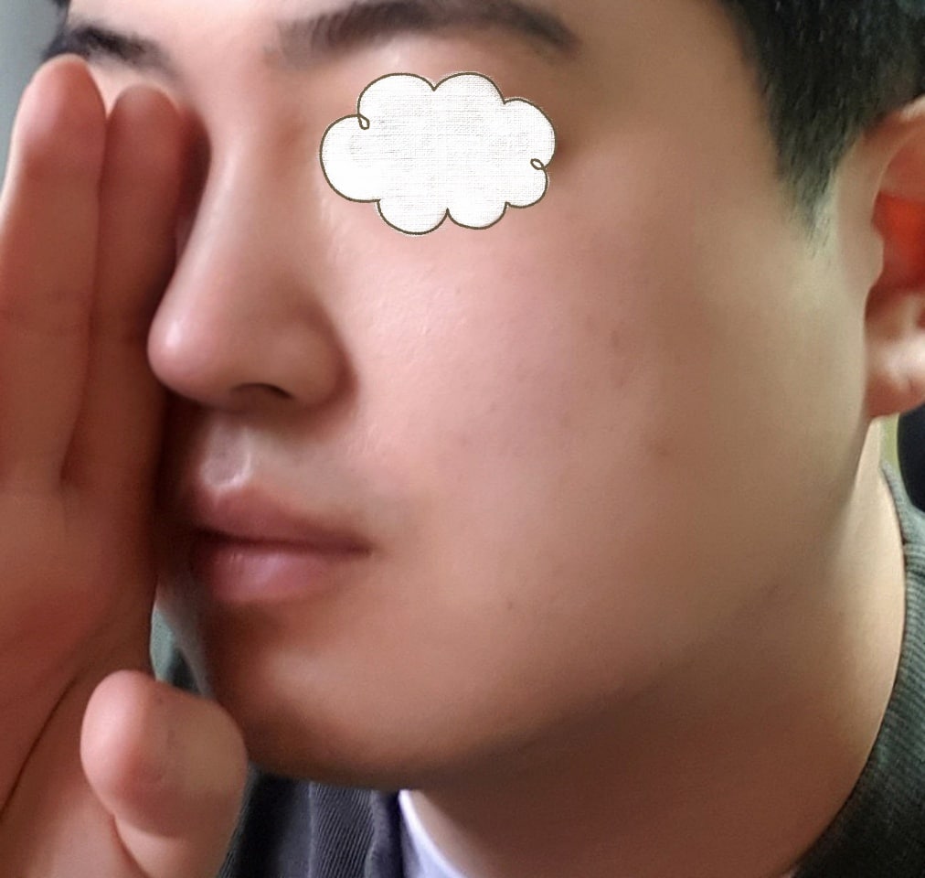 매부리, 화살코, 비중격만곡증 수술후기