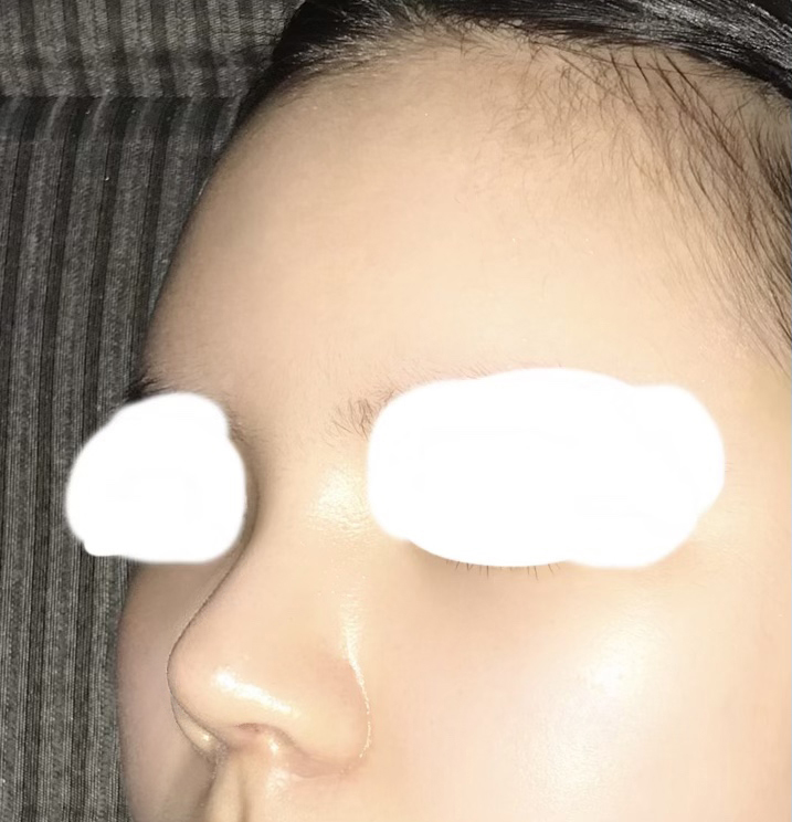 코성형, 지방이식수술한 후기!