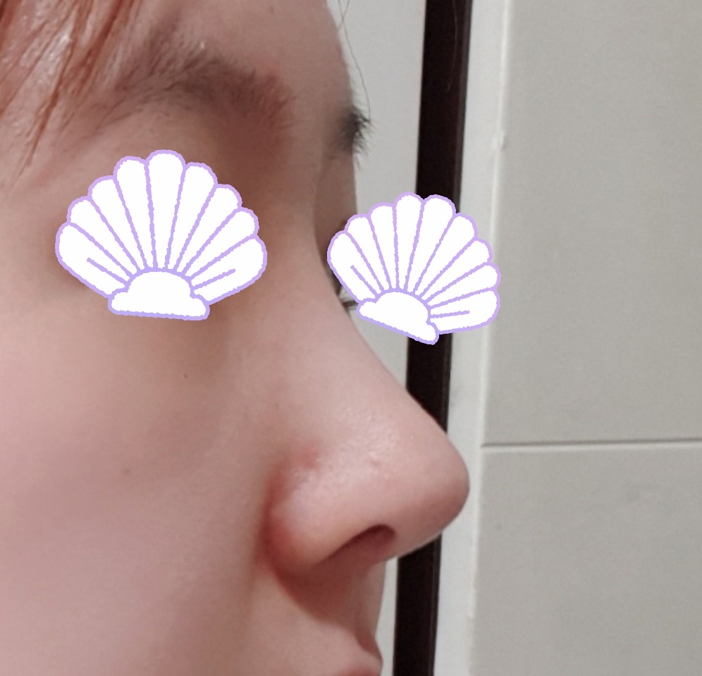 바이브에서 수술받은지 6개월 다 돼가요!!