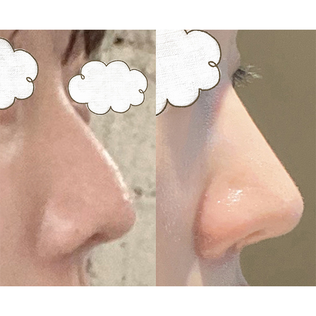 코3번째수술!! 어느 각도에서 봐두 이뽀요~