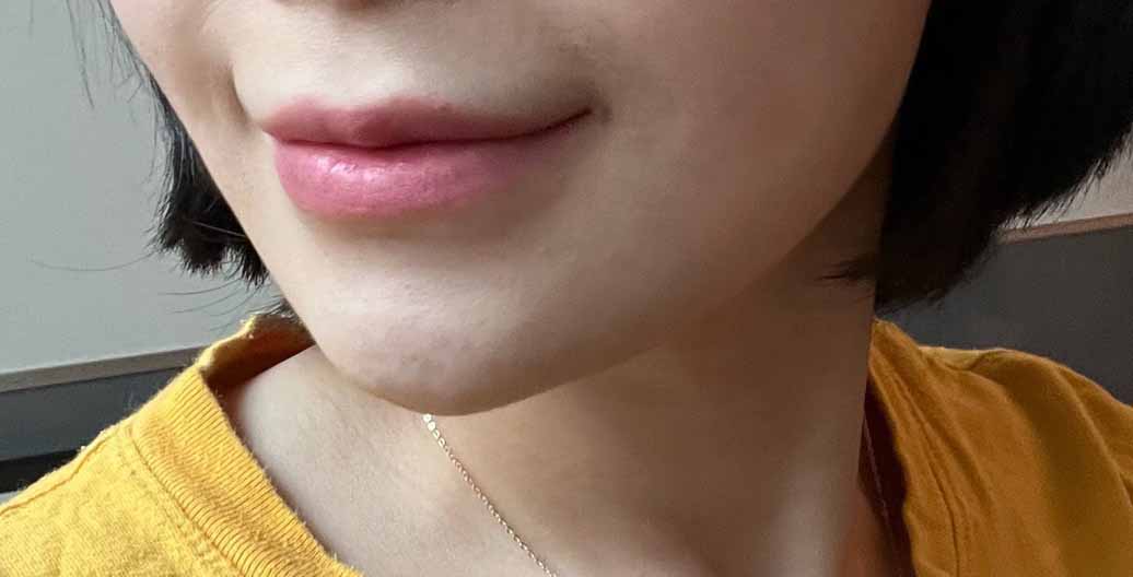 얼굴지방흡입 하고 턱선이 살아남ㅎ