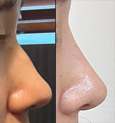 바이브에서 기능코성형했습니다~