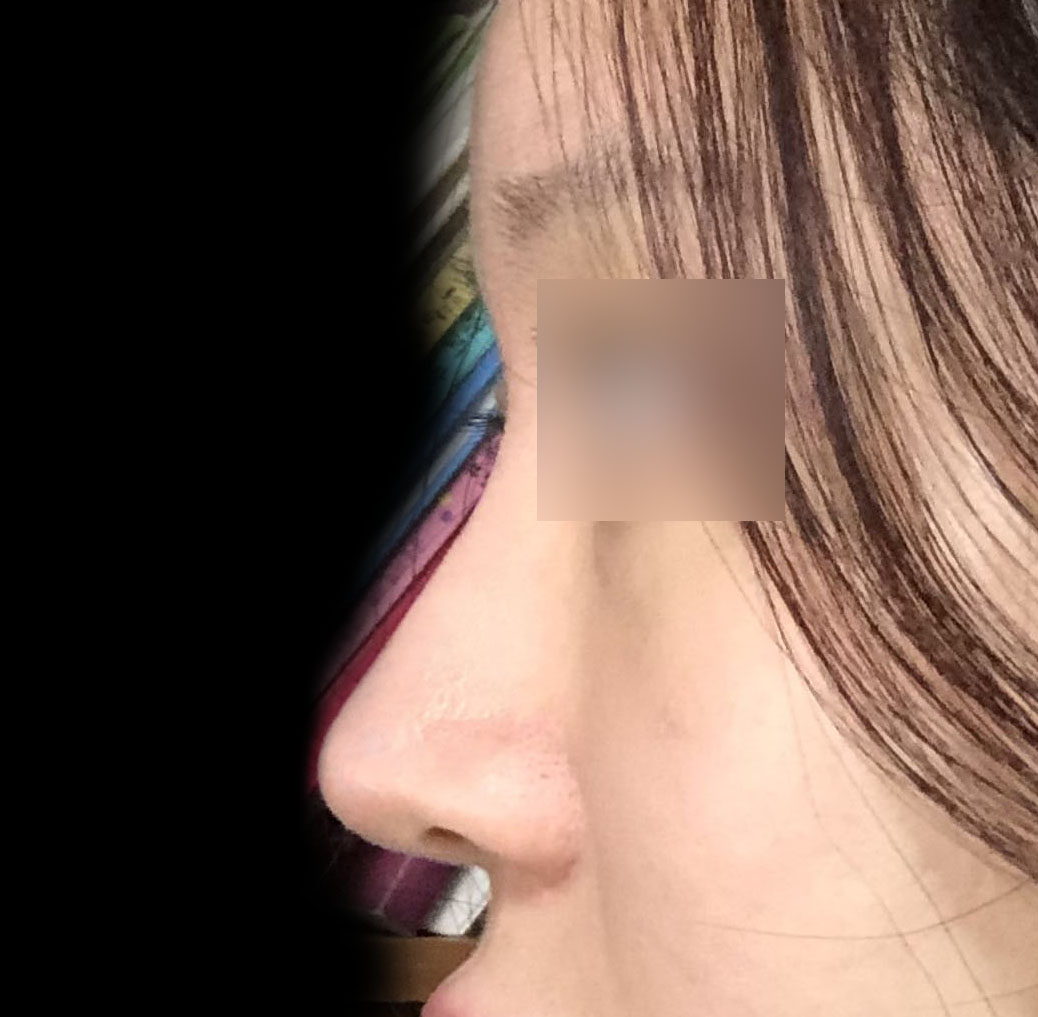 기능코+미용코수술, 4개월차후기^0^