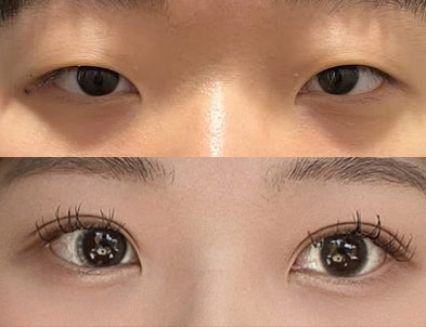 눈매교정한지 7개월지난 지금까지 정말 만족bb