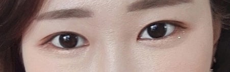 쌍수하고 이제 3개월차