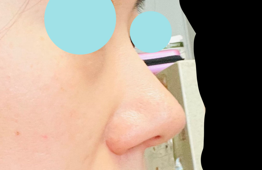 무보형물코성형 6개월차후기씁니다!