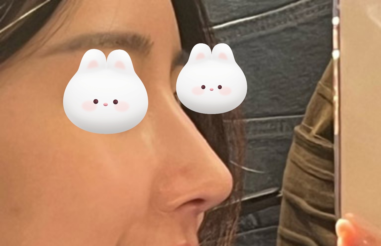 심한매부리코성형! 눈도 했는데 넘 잘됐어요 ㅠㅠ