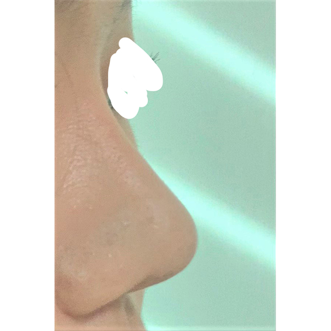 붓기도 거의 빠지고 자연스러워요 ㅎㅎ