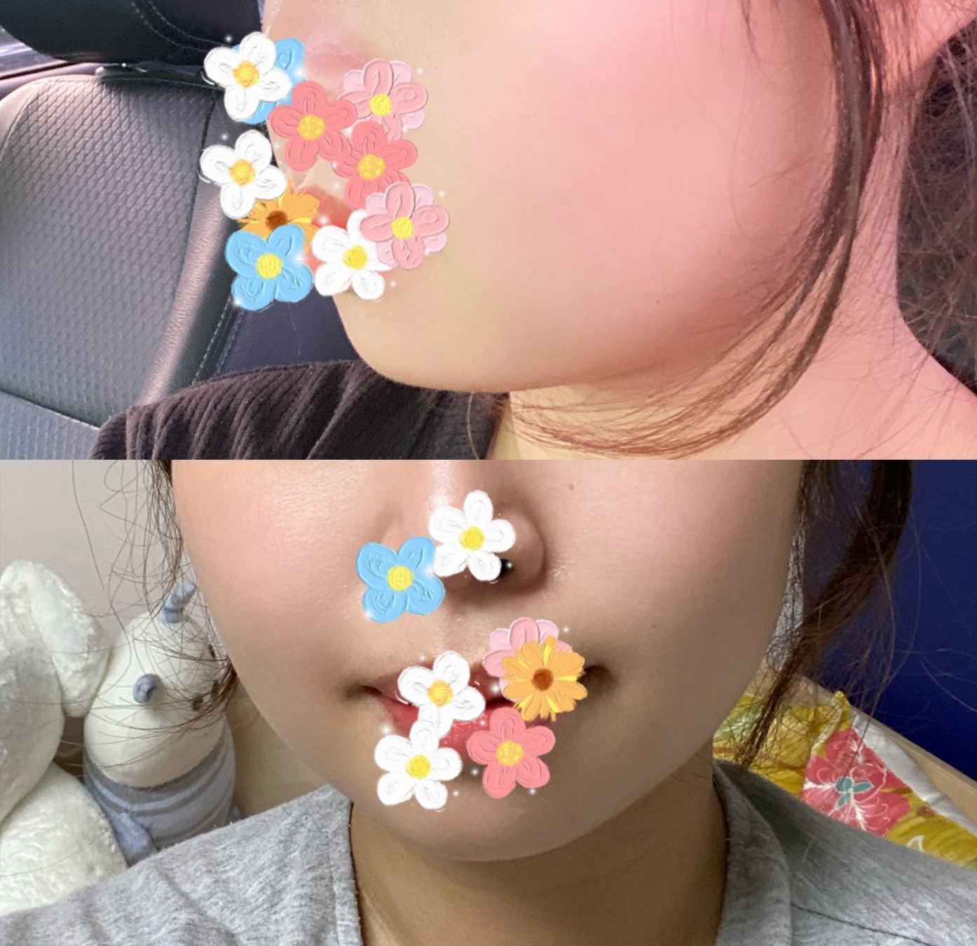 얼지흡 유명하다는 바이브에서 수술받았습니닷