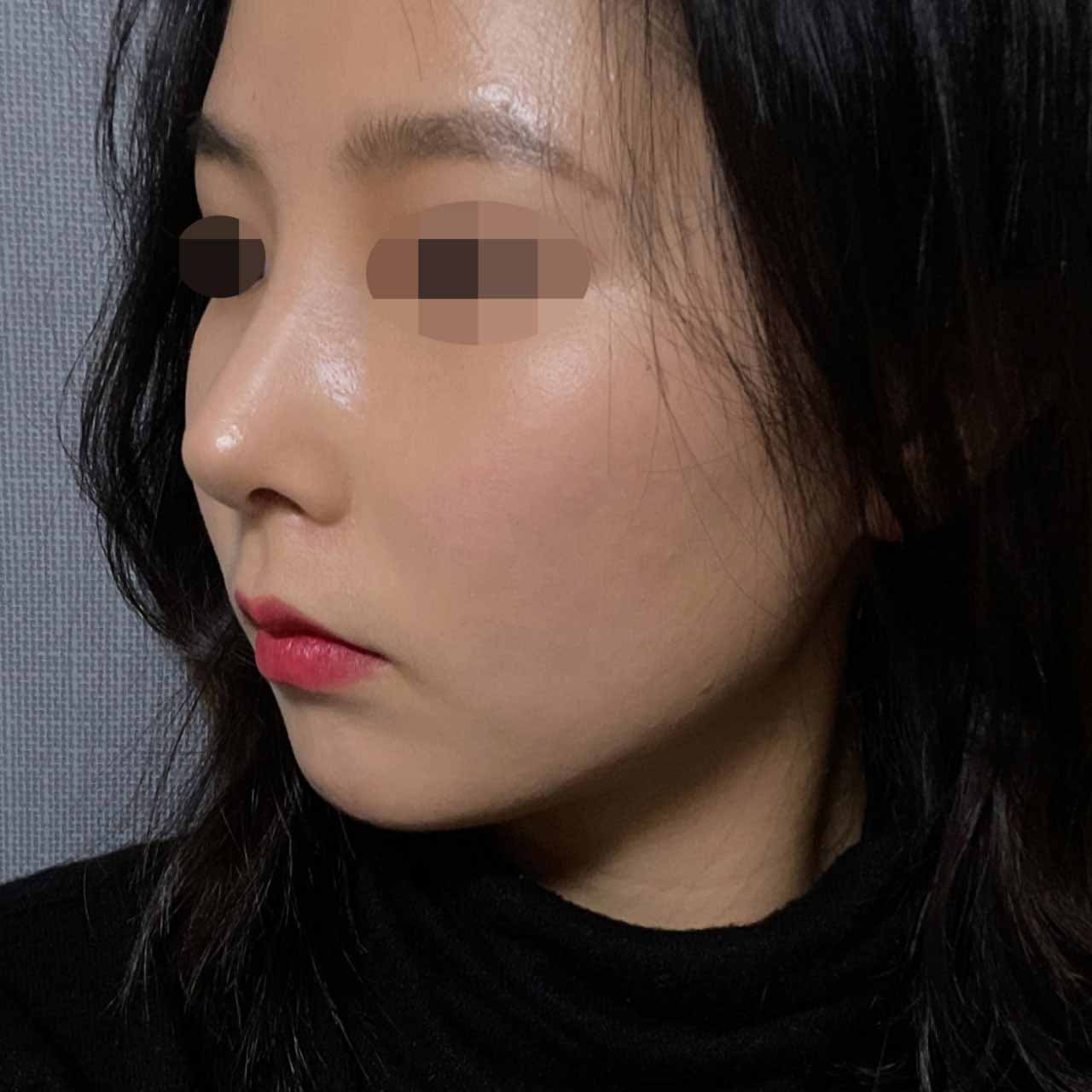 매부리가 잘 교정됐어요