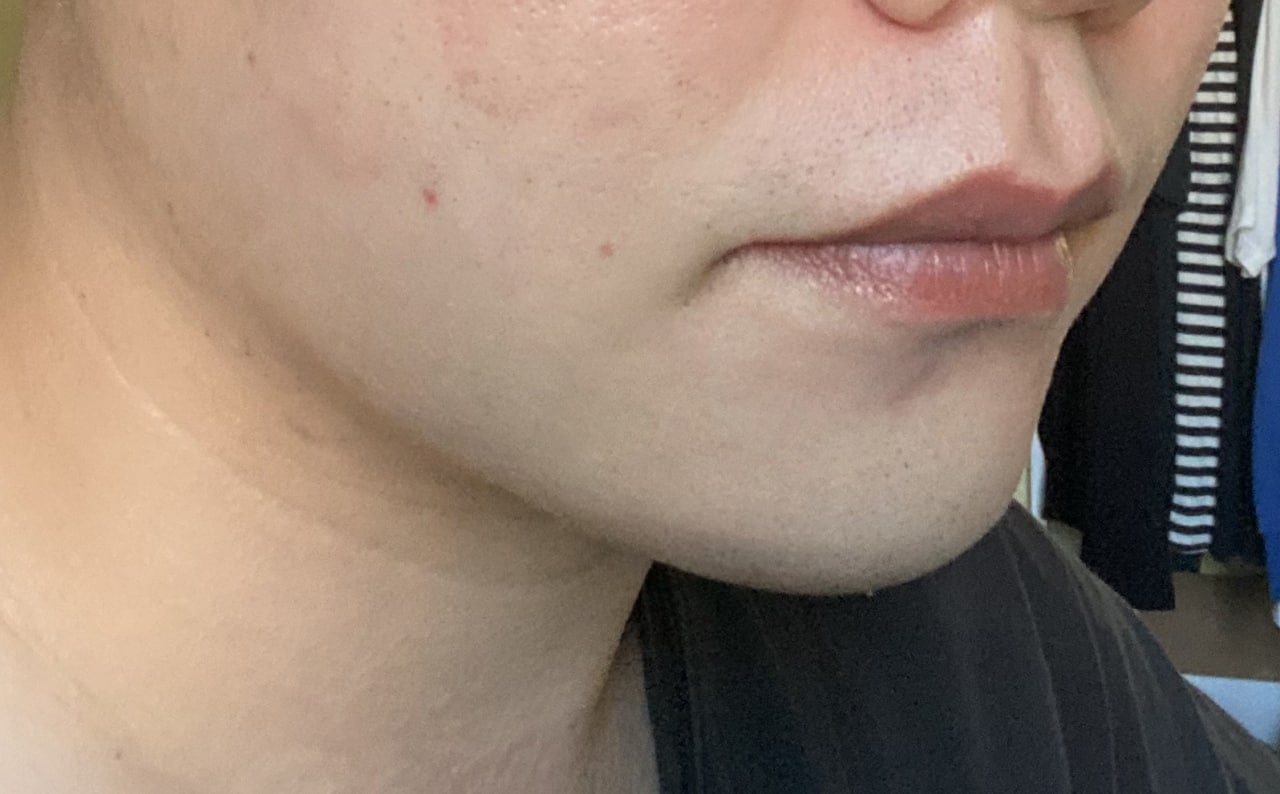 얼굴지방흡입이랑 턱끝필러 했습니다