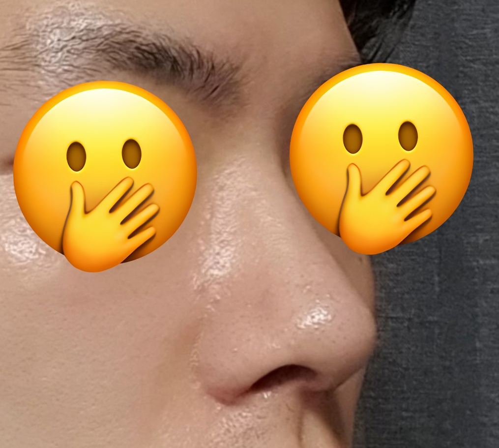 바이브에서 눈, 코성형 했습니다