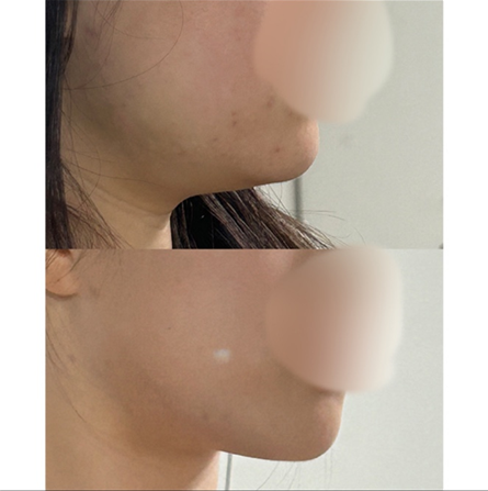 바이브 얼굴지방흡입 효과짱짱^.^bb