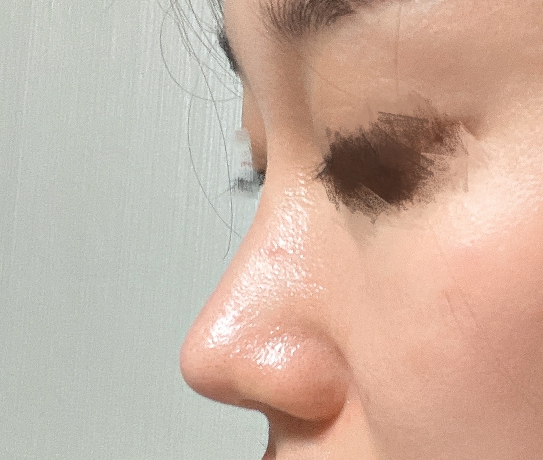 코성형은 바이브추천!!