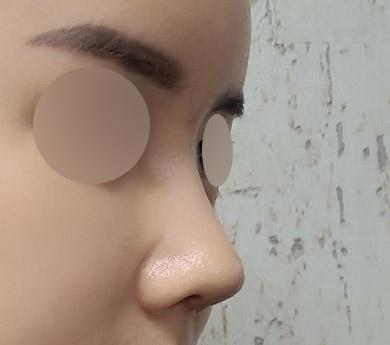 6년전 코수술 실패후 다시 재수술!