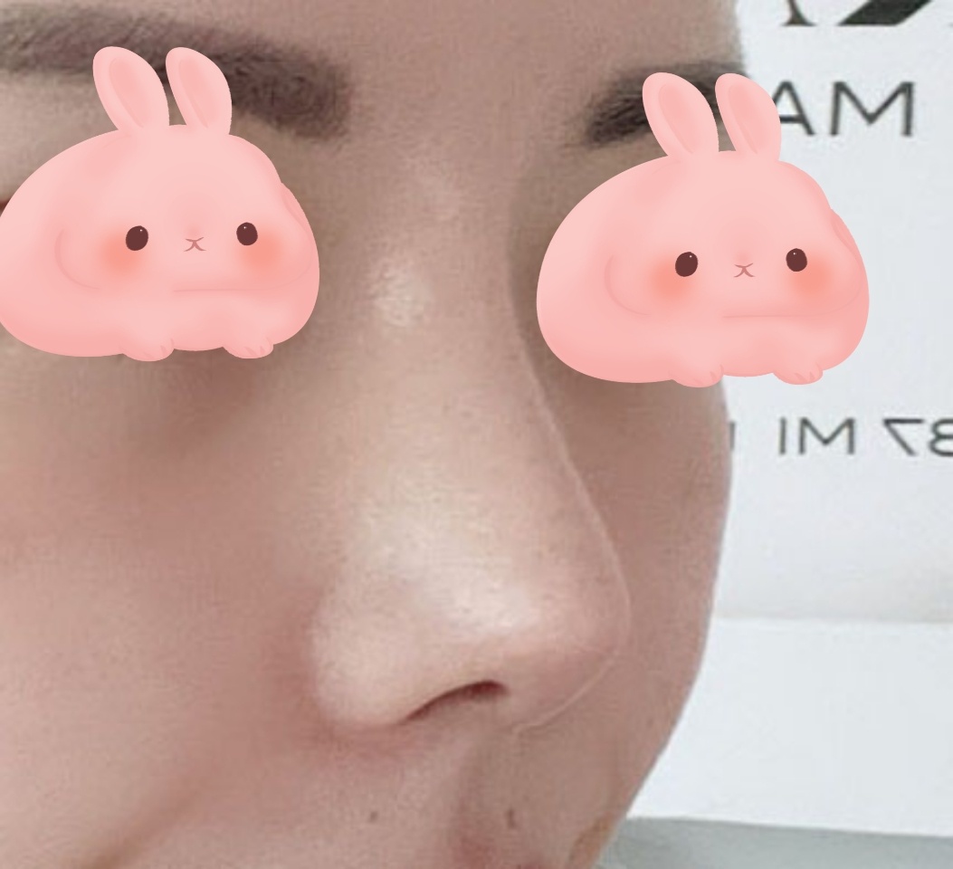 짧은코+복코성형 3개월차 후기입니당