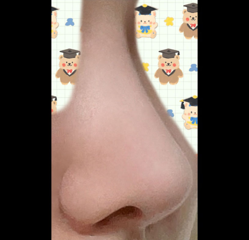 코수술 4개월넘어가요><완.전.만.족