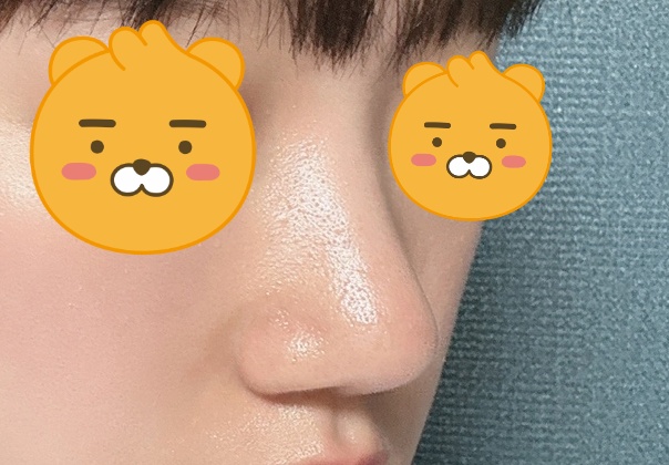 무보형물코수술 만족하고 지내욤!