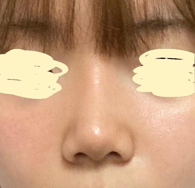 복코성형, 심부볼제거로 이미지가 세련돼졌어요 ㅎㅎ