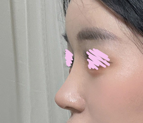 코성형4개월차! 대대만족쓰