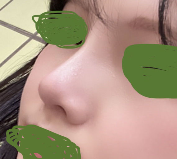 코수술 3개월차입니다!!