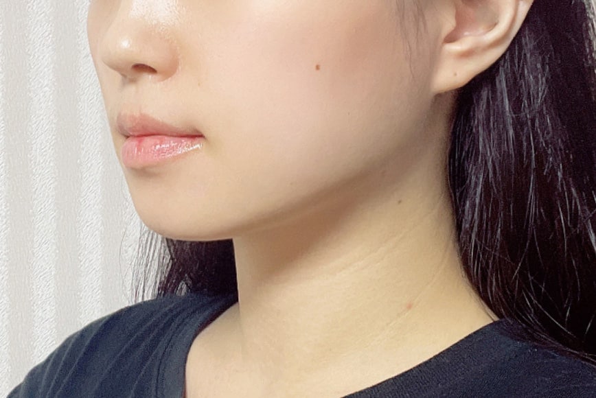 턱 지방흡입 효과 최고에용