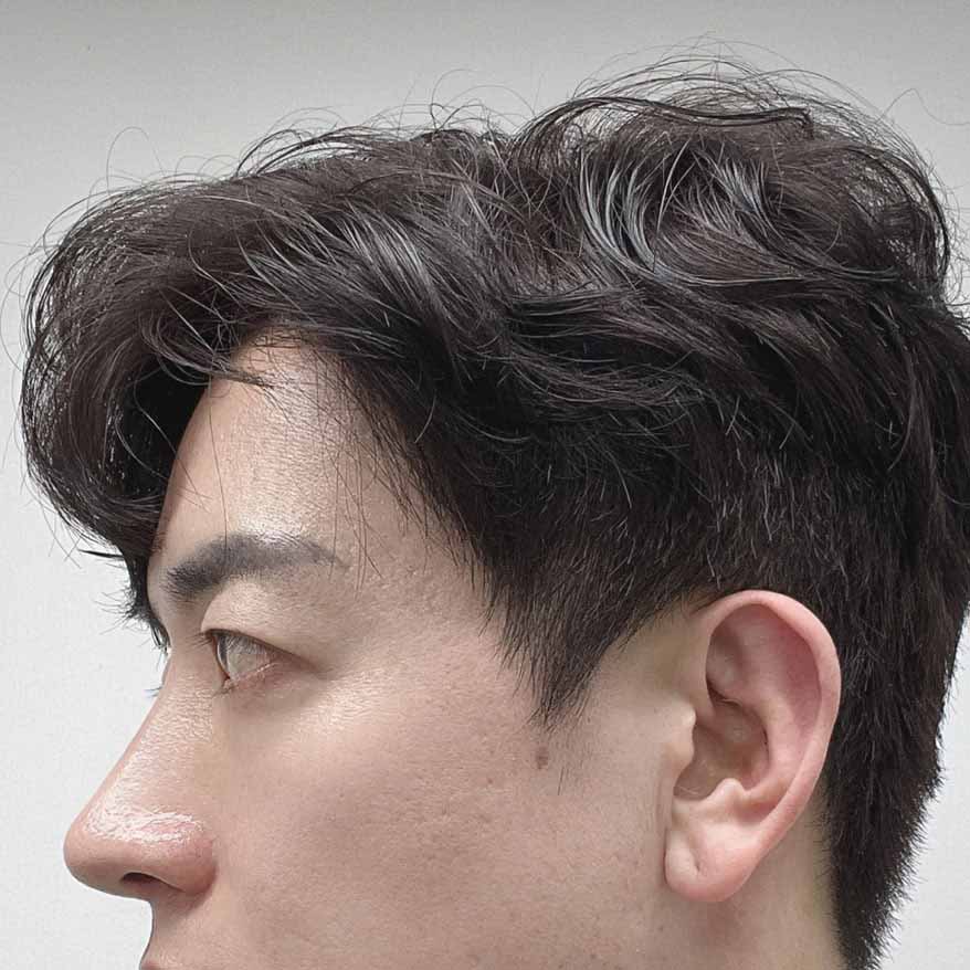 절개눈매교정+기능코성형 했습니다