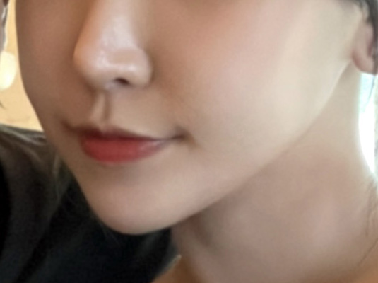 광대, 옆볼(심술보)흡입 효과 장난 없네요