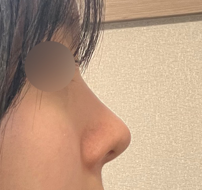 무보형물 코끝수술후기 ㅎㅎ잘됐죠?