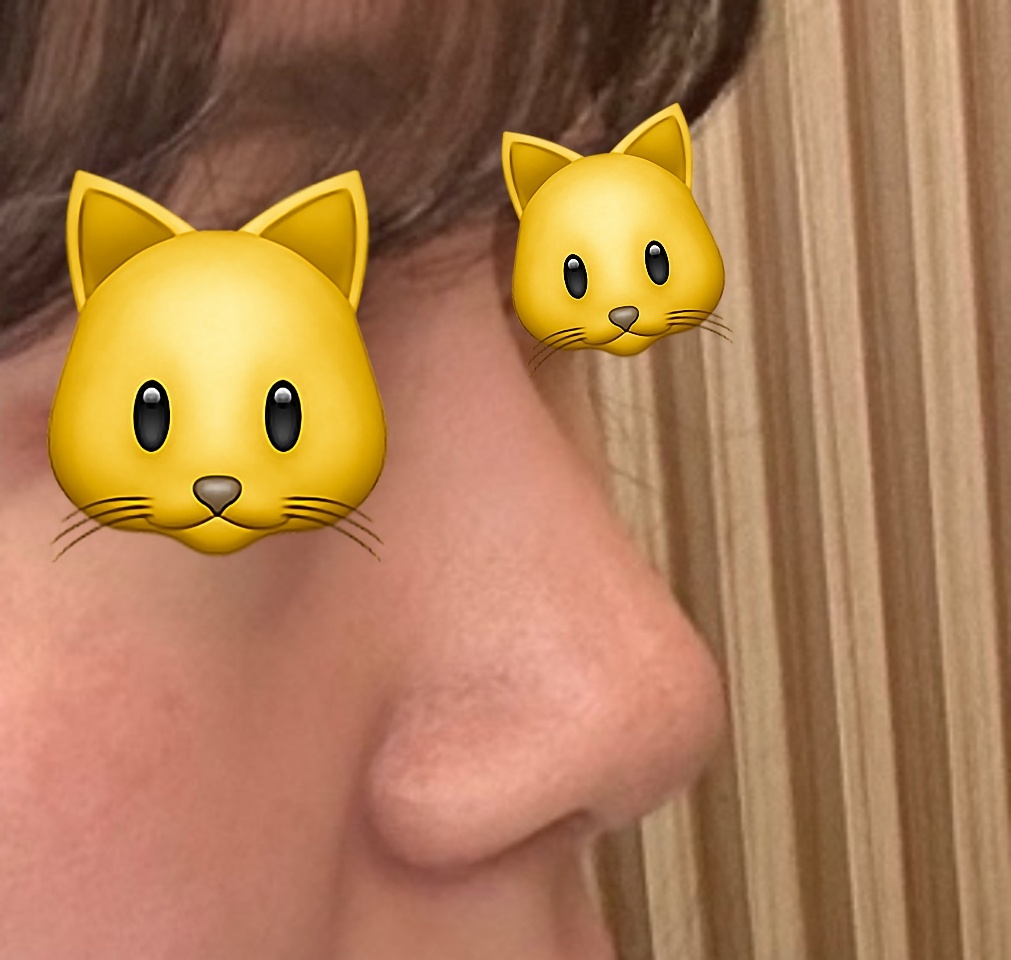 유원장님 코수술잘한다구 소문내고다녀요ㅎㅎ