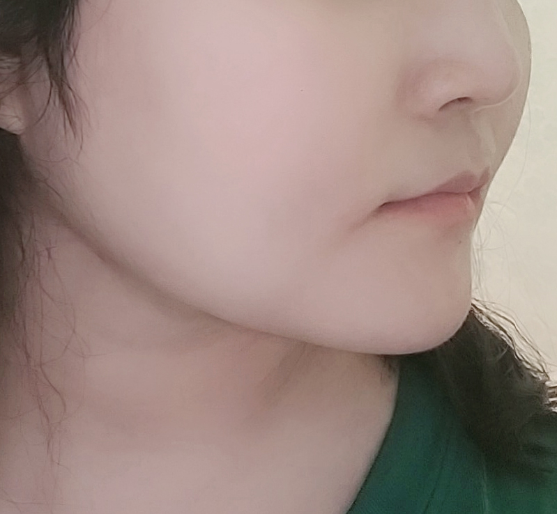 두툼히 있던 이중턱살, 목부분살 얄쌍해졌어요