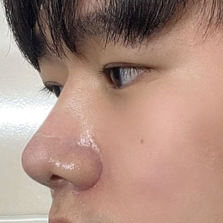 눈코수술 3개월차