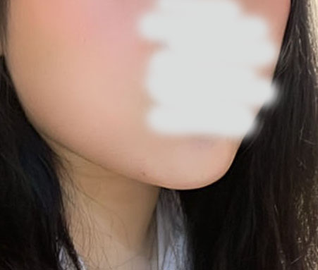 이중턱살 빠이빠이 보내버려써요~~