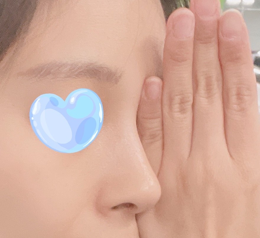 짧은코, 복코수술 4개월차입니당!