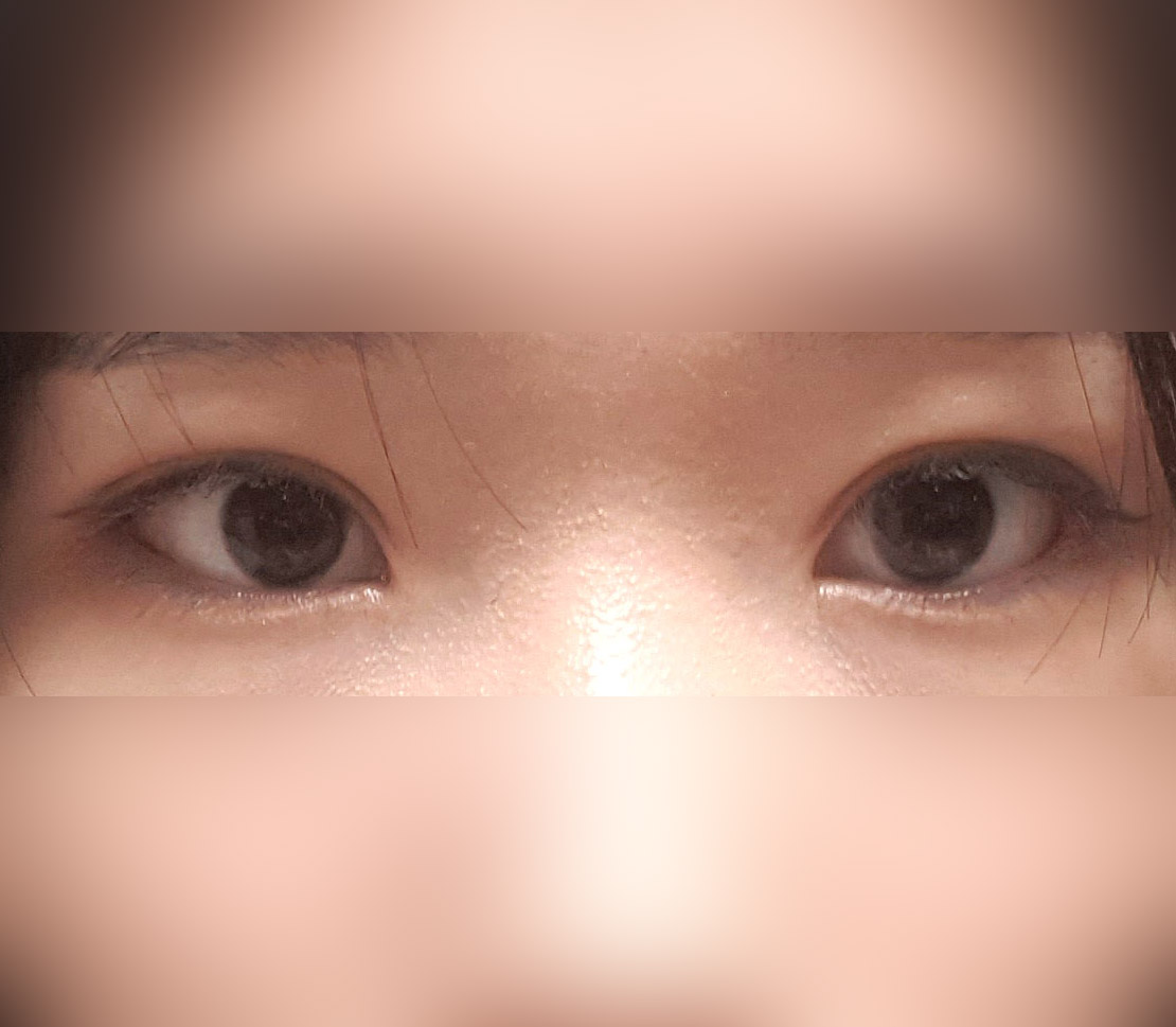 눈재수술2갤차~!