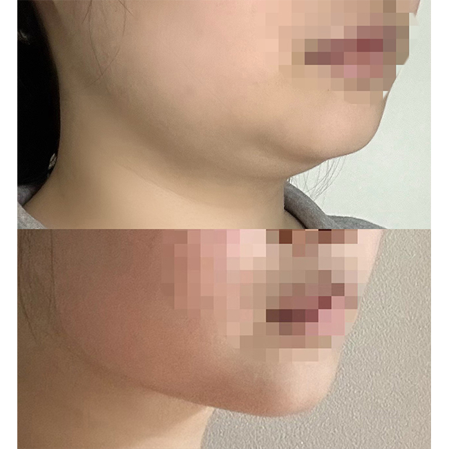 얼지흡으로 턱선날렵해진 후기~~