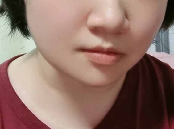 얼굴라인이 많이 정리됐어요!!!