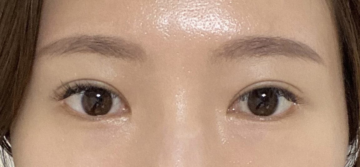 절개 재수술 성공적 ㅎㅎ