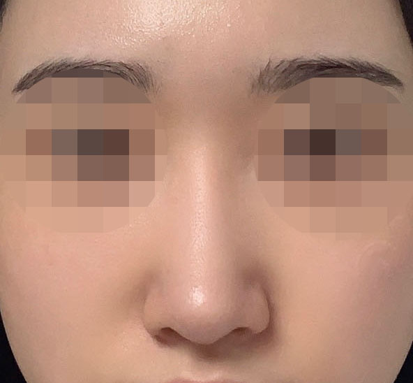 코수술 5개월차 찐후기ㅎㅎ!!